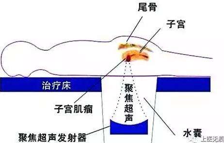 海扶治疗子宫肌瘤的适应症,海扶医疗子宫肌瘤