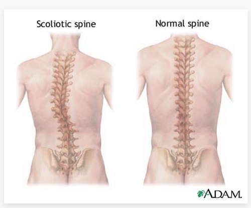 康睿仕脊柱侧弯矫正,康睿仕治疗脊柱侧弯吗