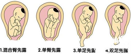 胎位不正会对妈妈宝宝有什么影响,胎位不正到后期怎么办