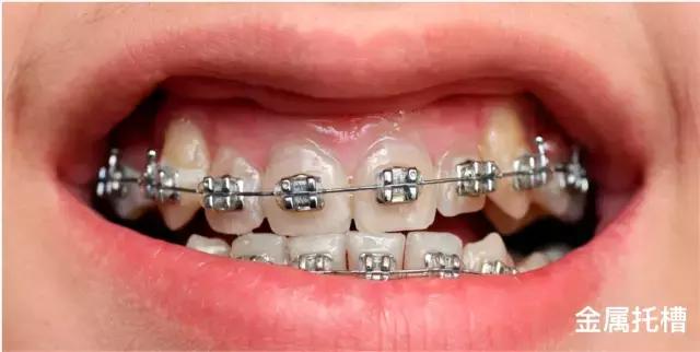 全口牙套的种类和价格,矫正牙套种类及价格表