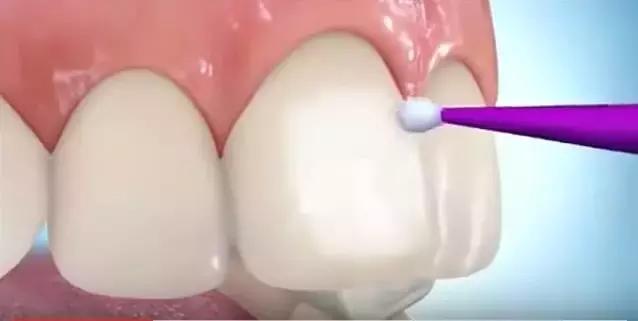 箍牙的牙套是怎么固定上去的,箍牙齿全过程图片