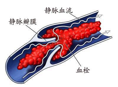 下肢水肿是什么症状引起的,肺动脉高压致下肢水肿病因