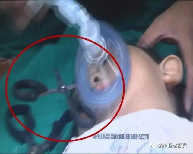 剪刀戳伤小朋友,剪刀戳伤孩子