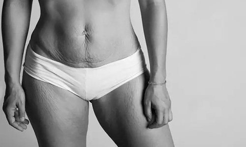 产后怎么快速消除大肚子,如何消除产后大肚子