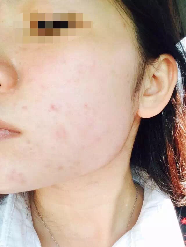 慎入！春季多发激素脸！你还要不要脸？