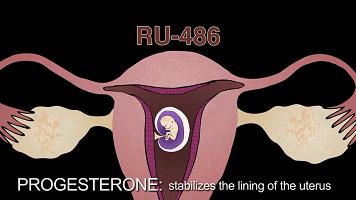 堕胎手术有多可怕,做了堕胎手术