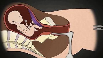 堕胎手术有多可怕,做了堕胎手术