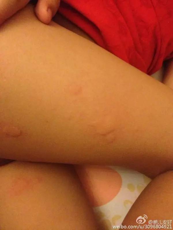 婴儿荨麻疹的治疗方法崔玉涛,崔玉涛荨麻疹