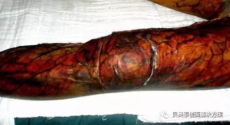 烧伤的诊断标准图表,烧伤病人典型症状