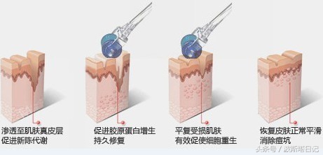 mts微针和美容仪哪个好,mts美容效果