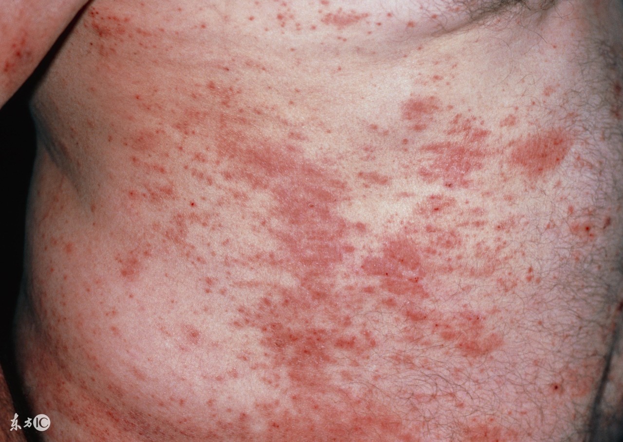 湿疹反反复复难治愈详细方案,幼儿湿疹中医辨证