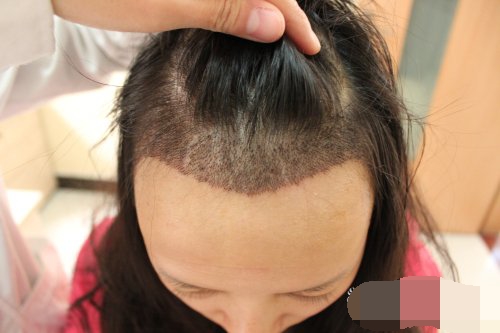 发问｜植发是选择植发机构还是三甲医院？