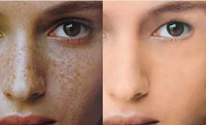 衡阳市激光祛斑,激光祛斑靠谱吗