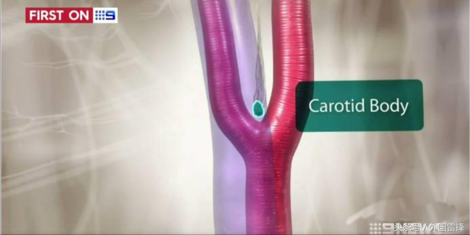 国外高血压防治指南,德国治疗高血压的方法