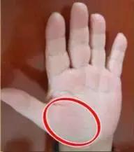 手上发紫中间发白,手上发紫发青还发痒是怎么回事