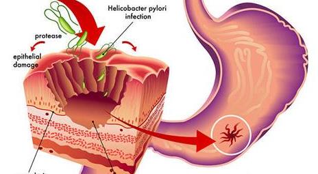 全国有最多的胃癌患者,全国胃癌最好的专家是谁