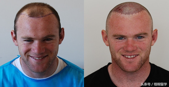 来英国后发际线高,在英国怎么保护发际线