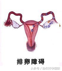 排卵障碍性子宫出血怎么治疗好,排卵障碍的病因及治疗方法