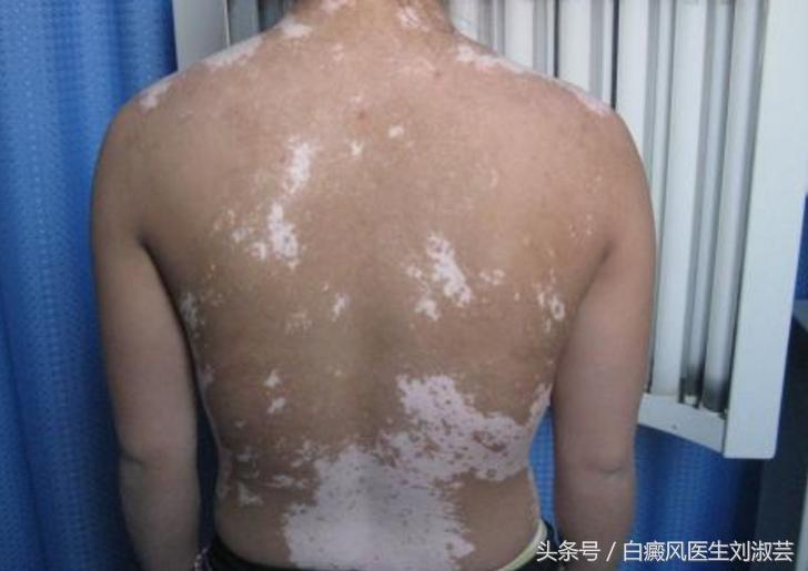 白癜风用补骨脂泡酒擦有作用吗,补骨脂和白蒺藜治白癜风