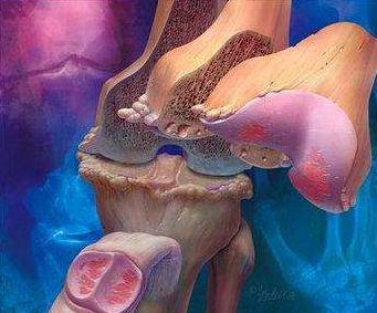 骨关节炎最新诊疗指南,骨关节炎医院排名