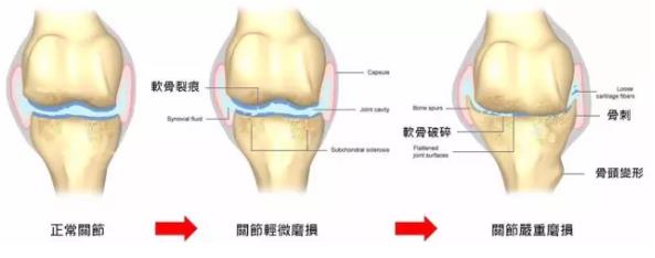 骨关节炎最新诊疗指南,骨关节炎医院排名