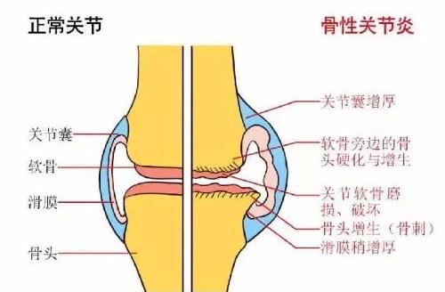 骨关节炎最新诊疗指南,骨关节炎医院排名