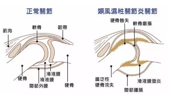 骨关节炎最新诊疗指南,骨关节炎医院排名
