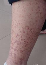 过敏性紫癜多久会复发一次,过敏性紫癜反复复发有什么危害