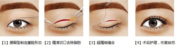双眼皮原来这么简单自然无痕,做过的双眼皮如何看起来自然一些