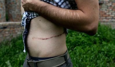 最应景的科普文：人如果少了一个肾会怎么样？