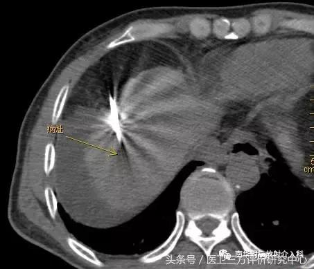 微波消融术后肿块多久才能消,甲状腺肿块微波消融