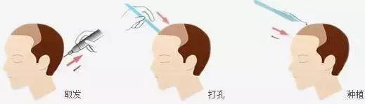 植发后怎么保养能让毛囊成活率高,植发一个月后如何判断毛囊存活