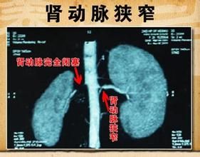 “普利”和“沙坦”，降压好“兄弟”，再说弟弟“沙坦”