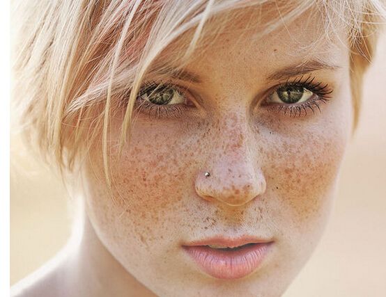 脸上一个斑皮下一窝斑是真的吗,脸上的斑时而淡时而显是什么斑