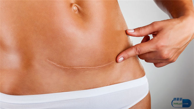 产后伤口没缝好怎么办,上门产后伤口护理