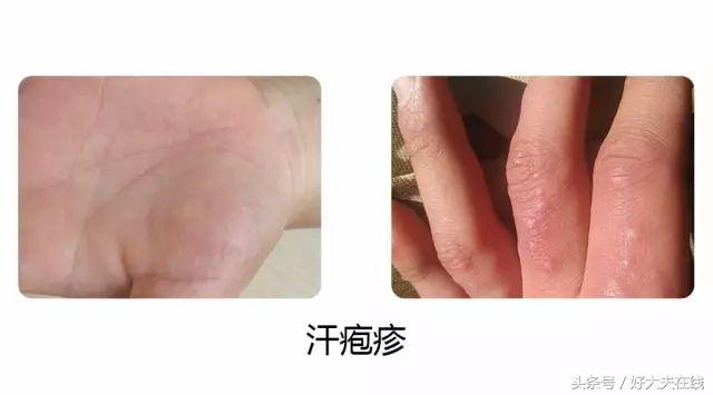 手上起小水泡是什么病,手上长小水泡一挤就流水是什么病