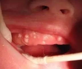 刚开始长牙的宝宝牙缝大的原因,刚出生的小孩嘴里长牙怎么回事