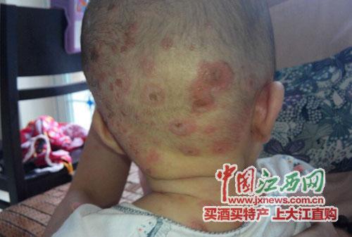 孩子在幼儿园被传染上虱子怎么办,小孩被传染疮了怎么办