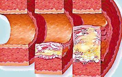 半导体激光真的可以降血压降三高,血液净化能治疗高血压吗