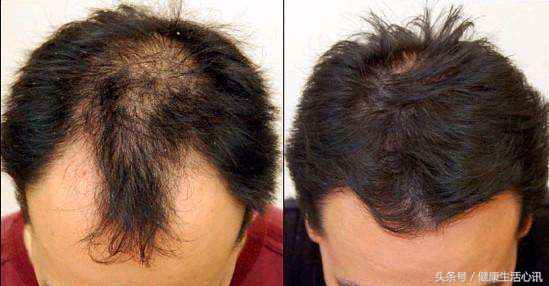 头发出油头皮屑多脱发是什么原因,头发容易油还脱发怎么办