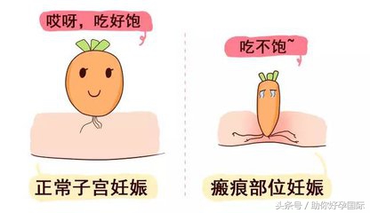 瘢痕子宫怀孕后要注意些什么,瘢痕子宫再怀孕需要注意什么