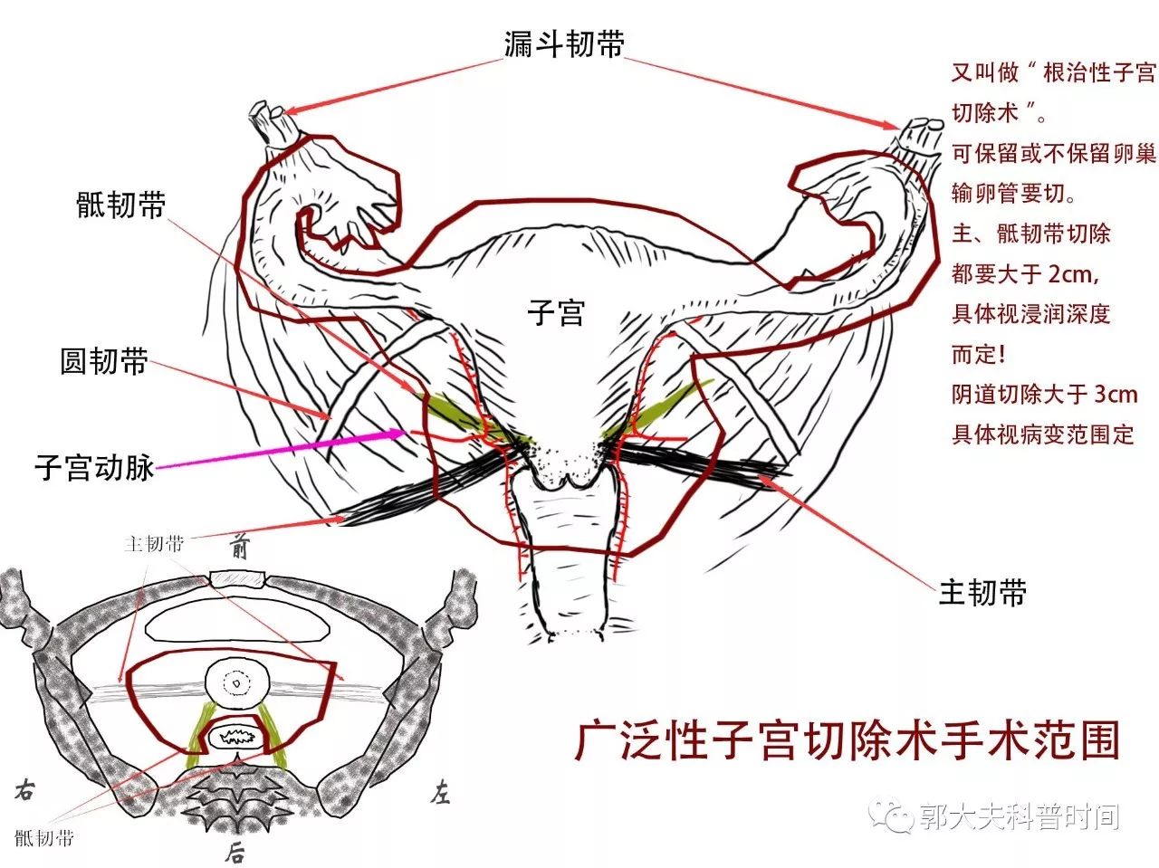 关于子宫切除的小秘密（一）——切除范围