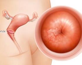 hpv筛查宫颈液基细胞学检查,宫颈hpv检查结果怎么看