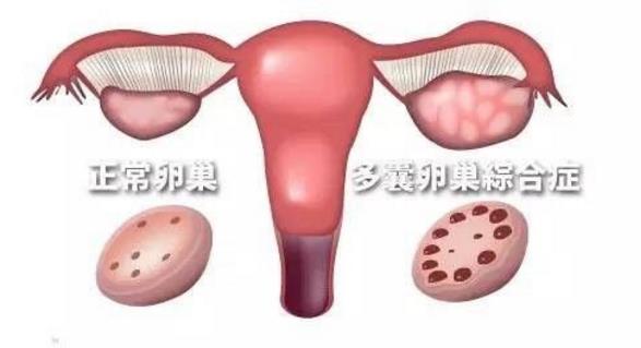 “痘妞”、“毛妹”，小心多囊卵巢综合征！（附靠谱的三甲医院名单）