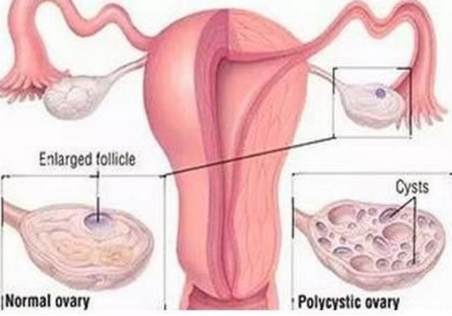 “痘妞”、“毛妹”，小心多囊卵巢综合征！（附靠谱的三甲医院名单）