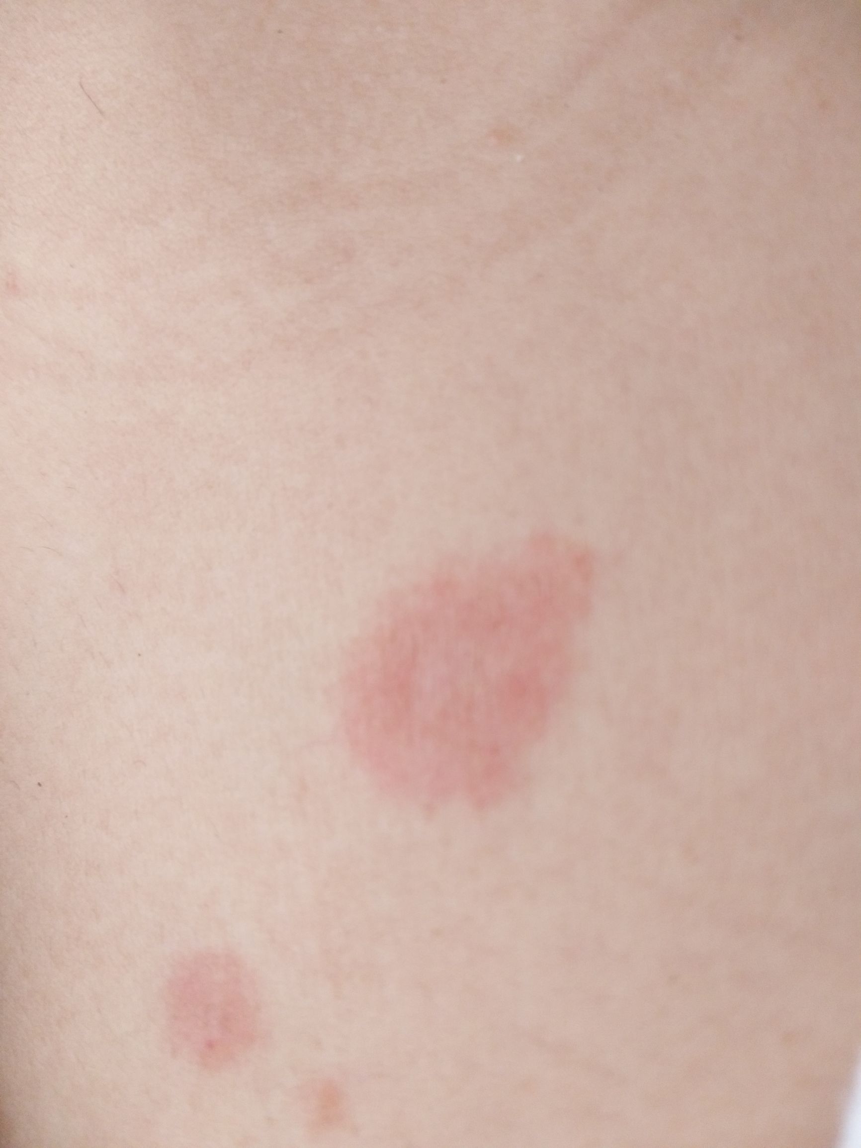 玫瑰糠疹有什么需要注意的,玫瑰糠疹自愈后还需要忌口吗