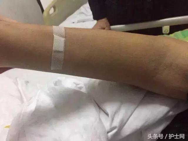 输液时液体外渗怎么办？