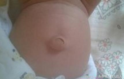 孩子肚脐长瘤代表什么,小孩肚脐有个肉瘤