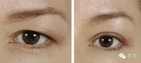 抬头纹手术会不会影响眼睛,抬头纹手术后有后遗症吗