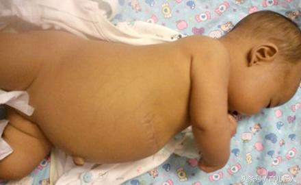 孩子肚脐长瘤代表什么,小孩肚脐有个肉瘤